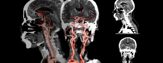 angiography